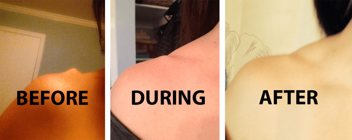 Three stages of shoulder tattoo removal: before, during the fading process, and after the tattoo is no longer visible.
