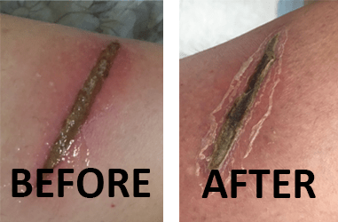 One day after wound healing with ozone treatment.
