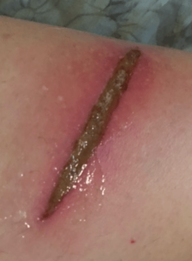 A close-up image of human skin undergoing Medical Ozone Therapy with a long, dark, and moist-looking leech attached.
